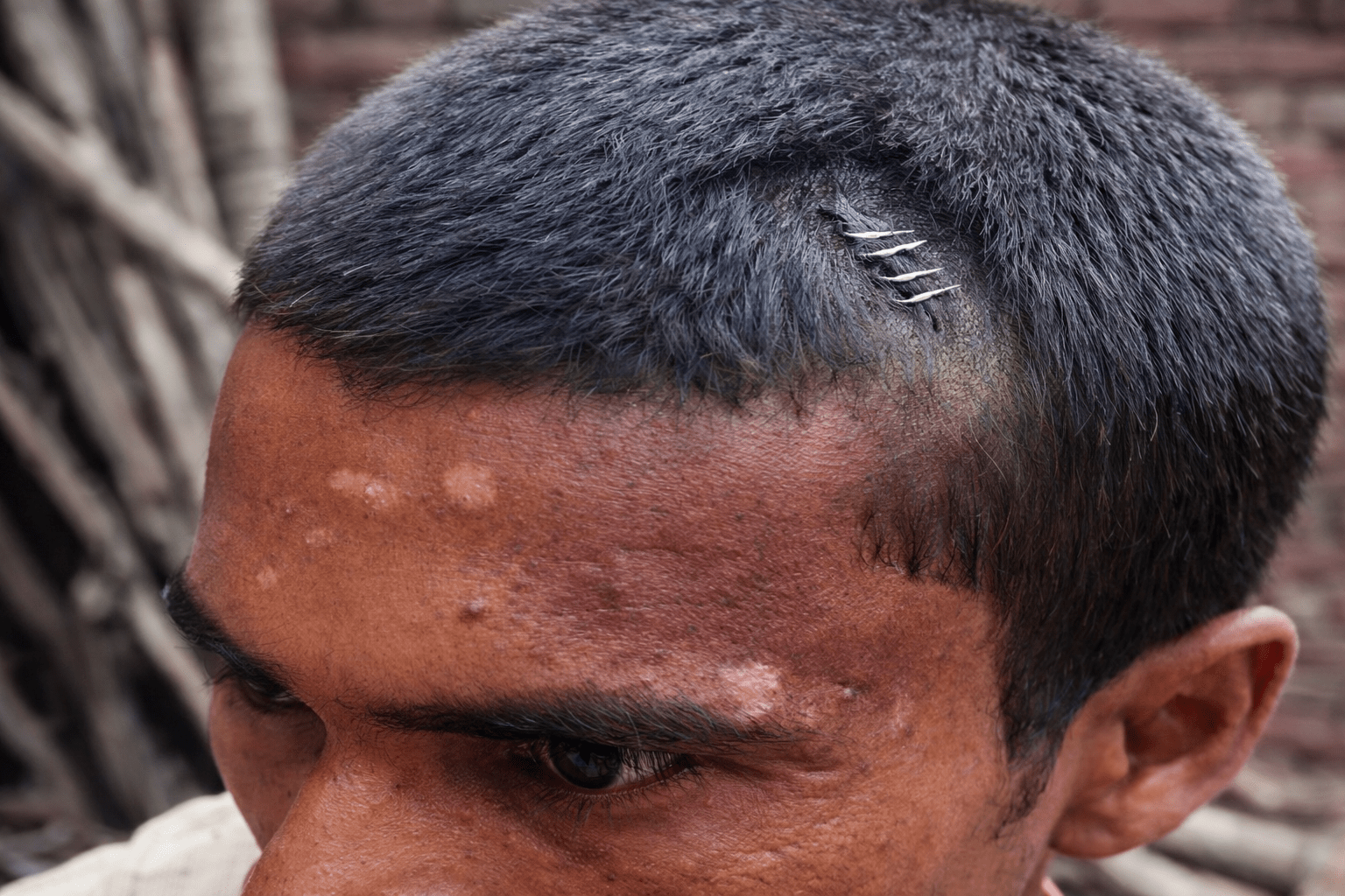 नवादा में झोलाछाप डॉक्टर की लापरवाही: सिर फटने पर टांकों की जगह लगा दी स्टेपलर पिन, वीडियो वायरल